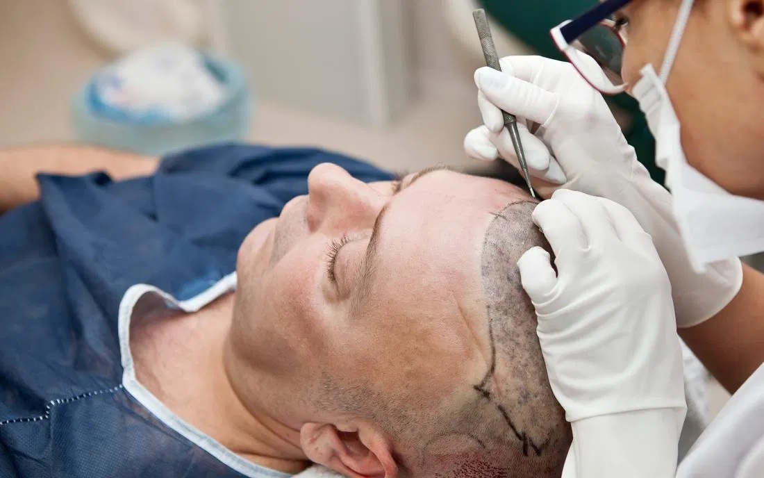 Does Hair Transplant Cost Depend On The Technique Used For Surgery?